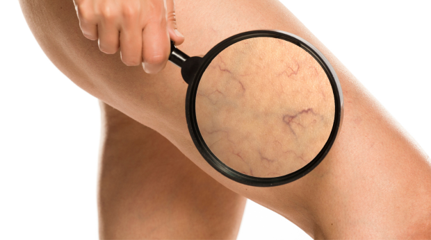 The Low Down on Veins