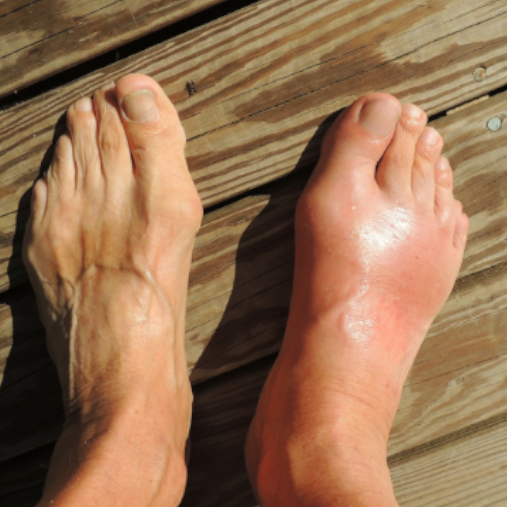 Do you suffer from Gout?