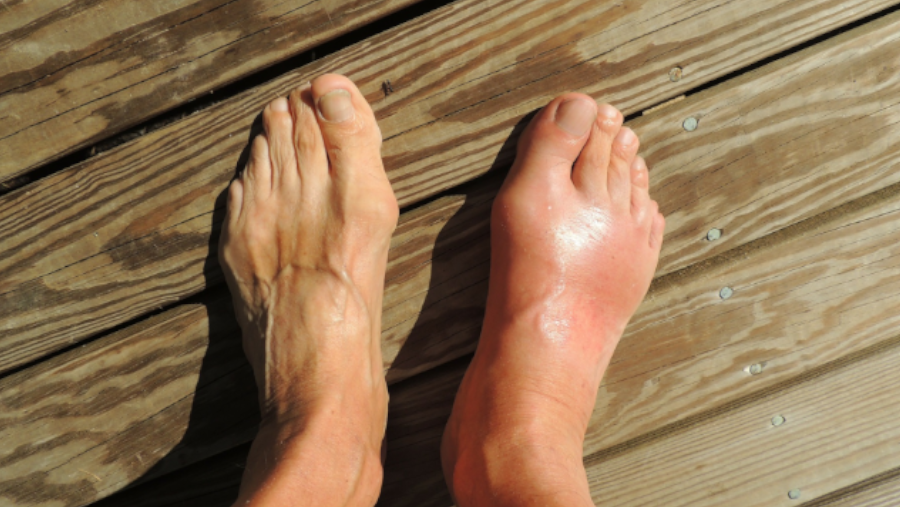 Do you suffer from Gout?